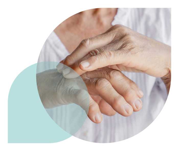 Ratgeber Rheuma: Eine Frau zeigt ihre angeschwollenen Fingergelenke