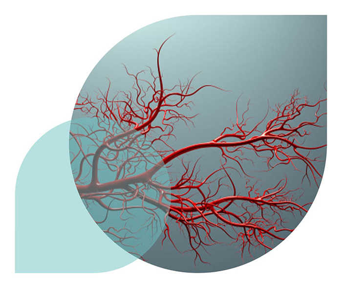 Ratgeber Rheuma: Teaser zum Krankheitsbild Vaskulitiden