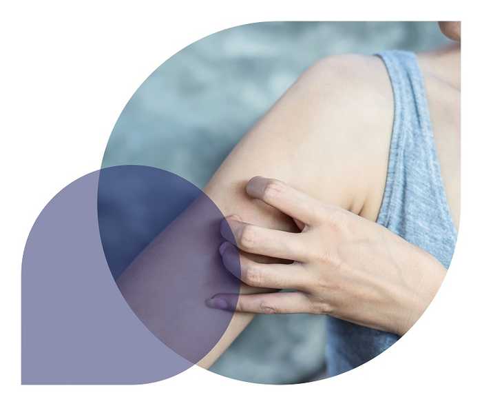 Ratgeber Rheuma: Eine Psoriasis-Patientin kratzt sich den Oberarm