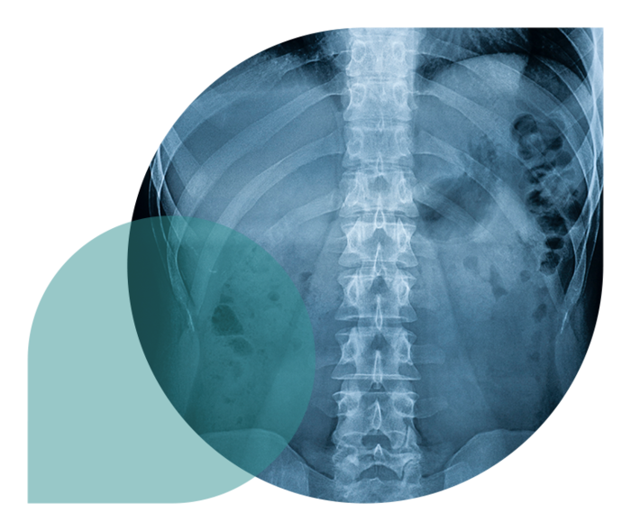 Ratgeber Rheuma: Röntgenbild einer Wirbelsäule