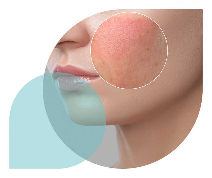 Ein Teaserbild der Symptome-Unterseite Kollagenose