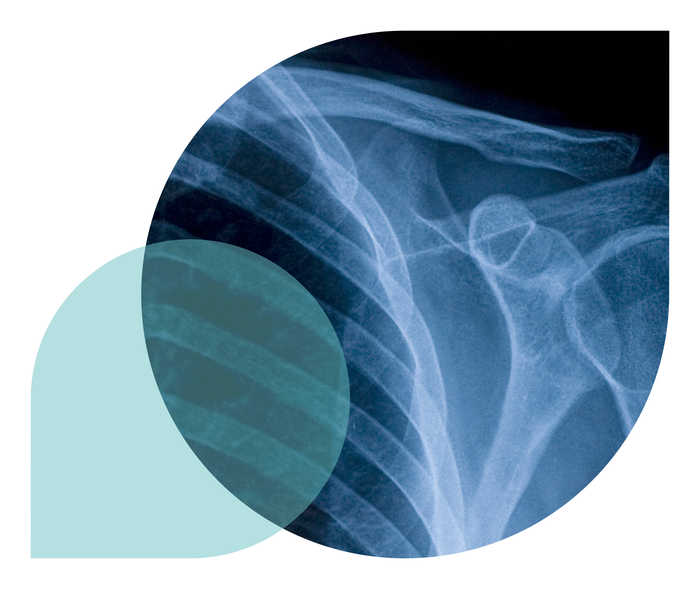 Ein Teaserbild der Polymyalgia rheumatica Seite