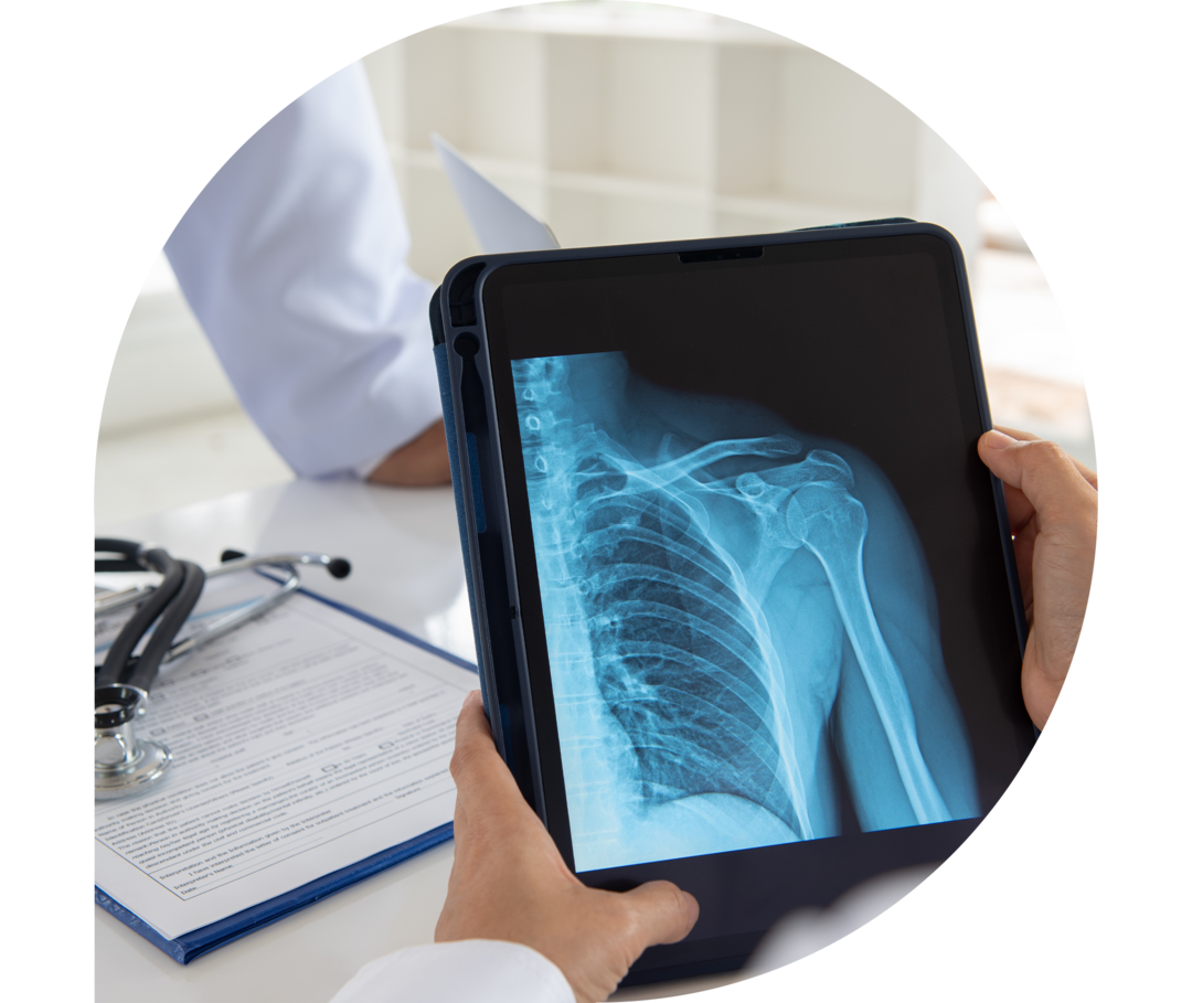 Ratgeber Rheuma: Rheuma-Arthritis Das Bild zeigt ein Röntgenbild des Schulterbereiches