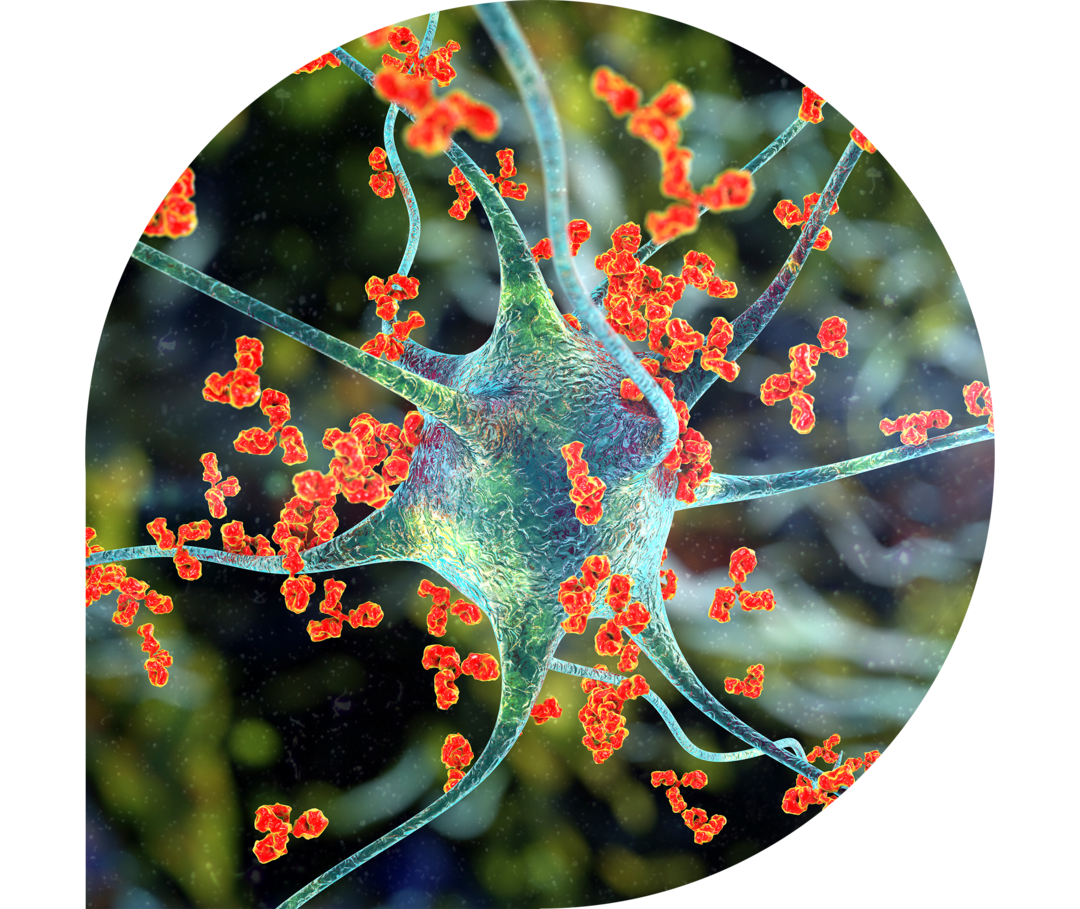 Ratgeber Rheuma: Psoriasis-Arthritis Das Bild zeigt eine Autoimmunreaktion