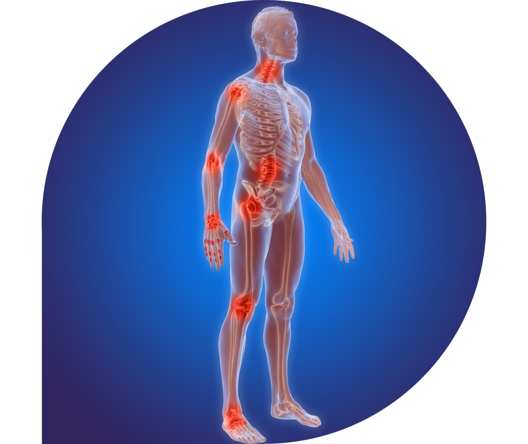 Ratgeber Rheuma: Rheuma-Arthritis Das Bild zeigt den Menschen mit Knochen und Muskeln