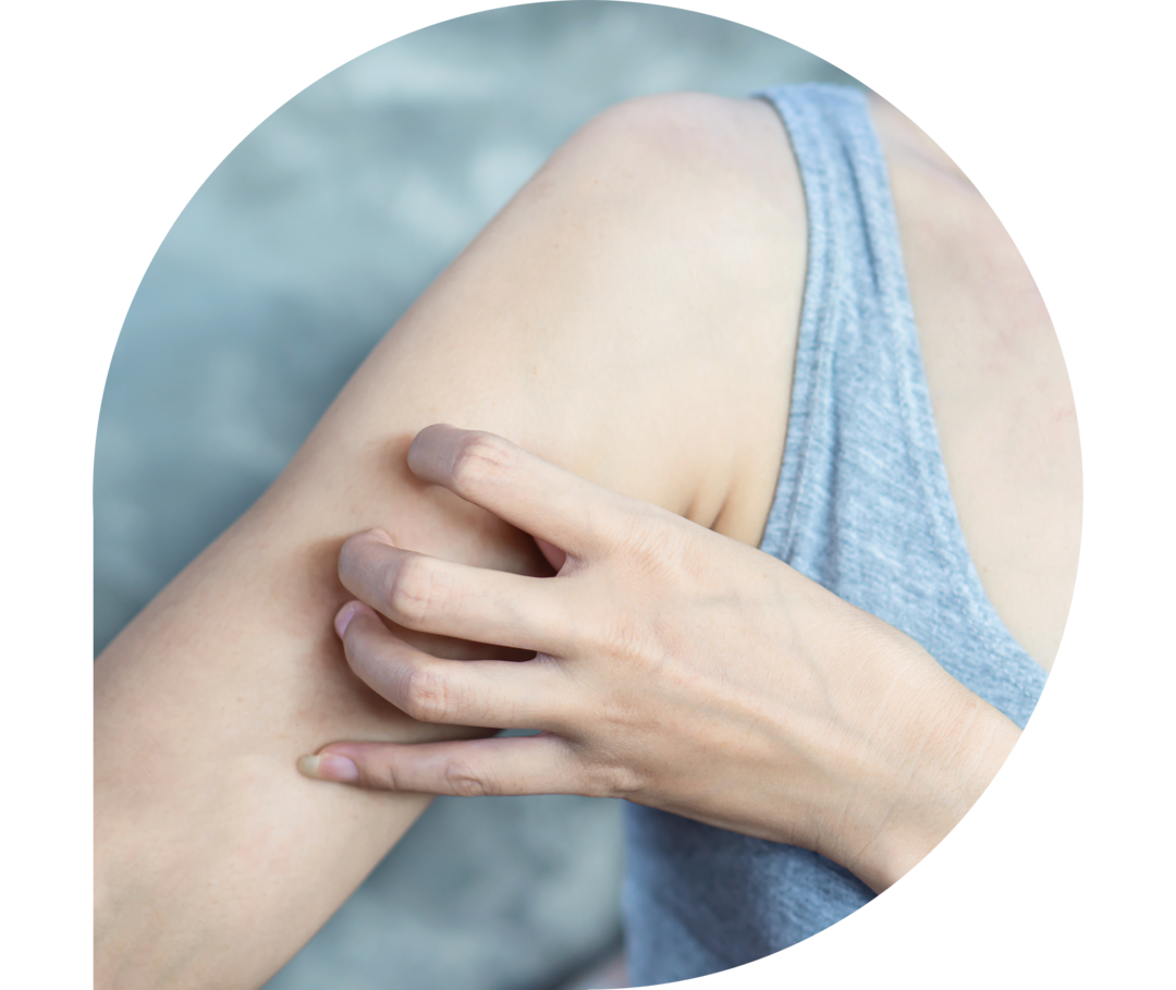 Das Artikelbild der Psoriasis Arthritis - Symptome Unterseite