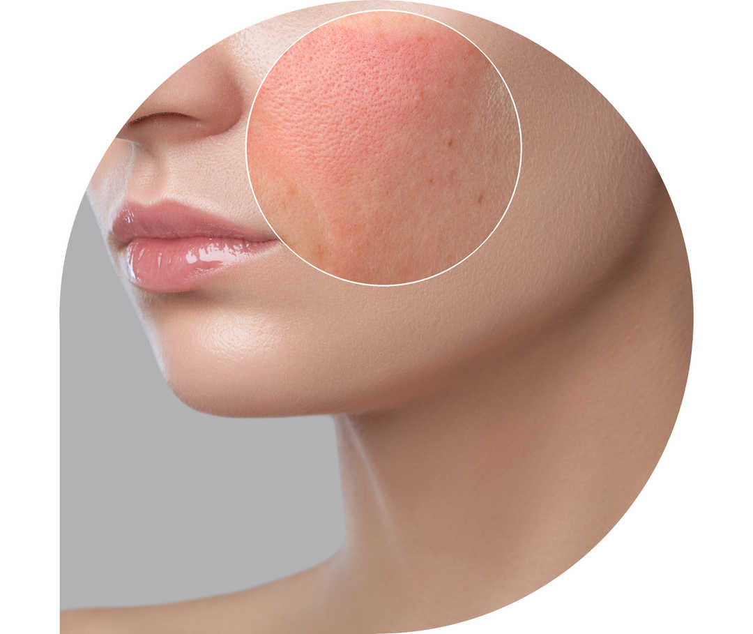 Ratgeber Rheuma: Eine Frau mit sichbaren Symptomen einer Kollagenose im Gesicht Ratgeber Rheuma: Eine Frau mit sichbaren Symptomen einer Kollagenose im Gesicht