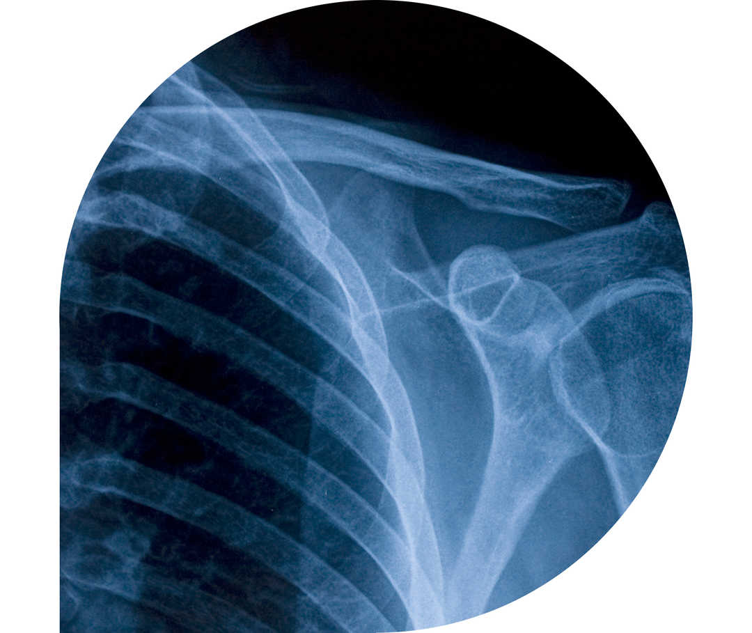 Ratgeber Rheuma: Schulter/Nacken-Skelett im Röntgenblick