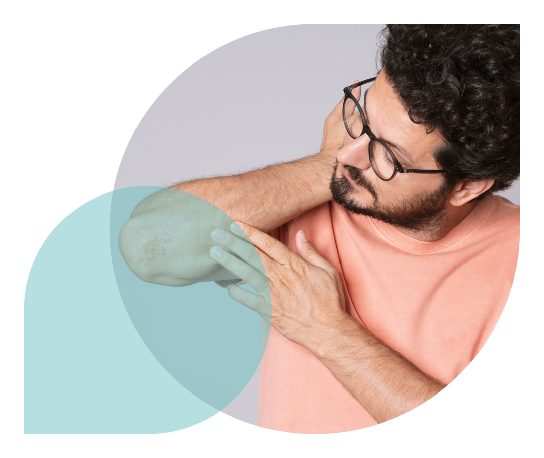 Ellenbogen eines Mannes mit leicht schuppigen Hautveränderungen