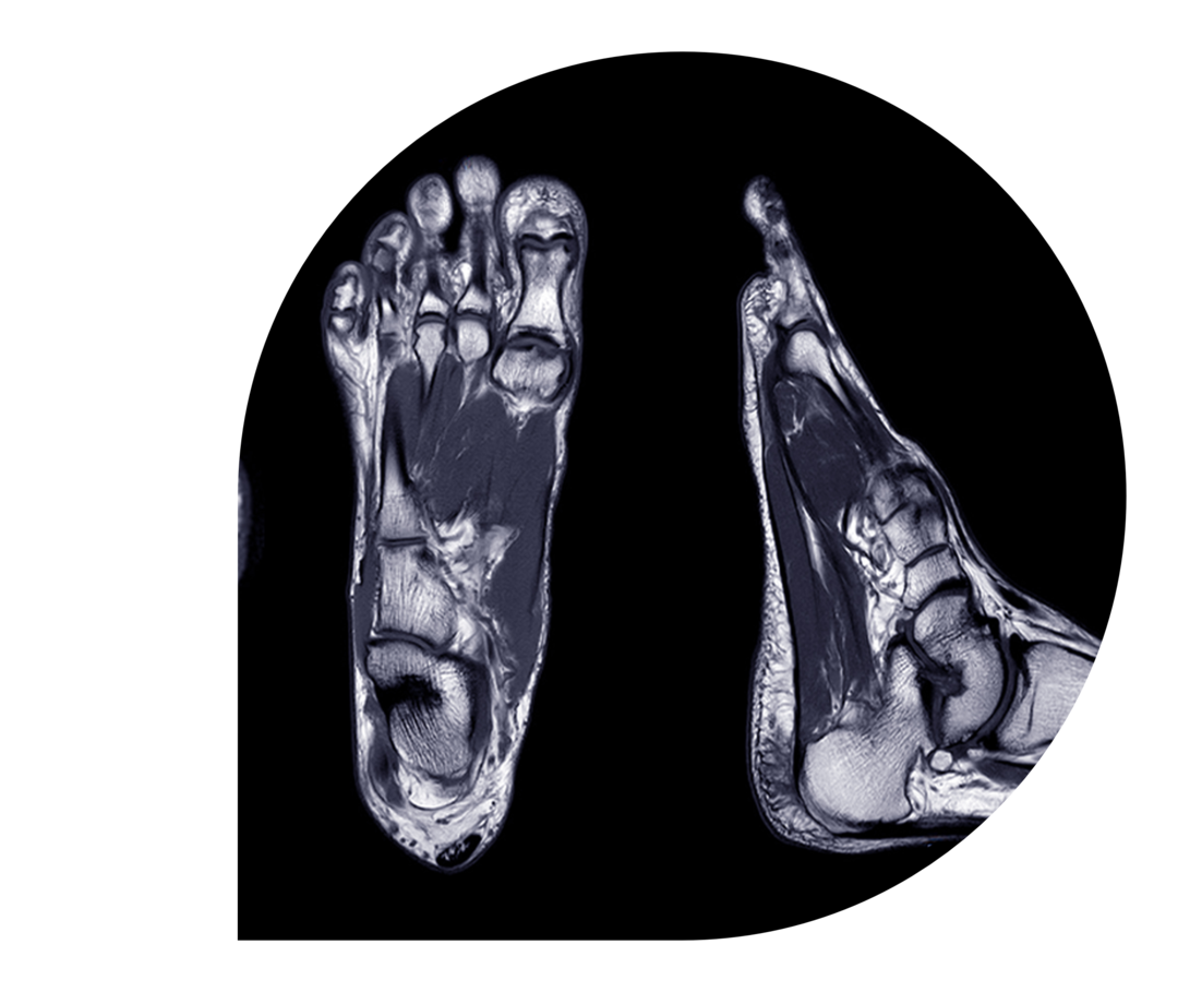 Eine MRT-Bild zeigt einen Fuß im Längsschnitt und im Querschnitt